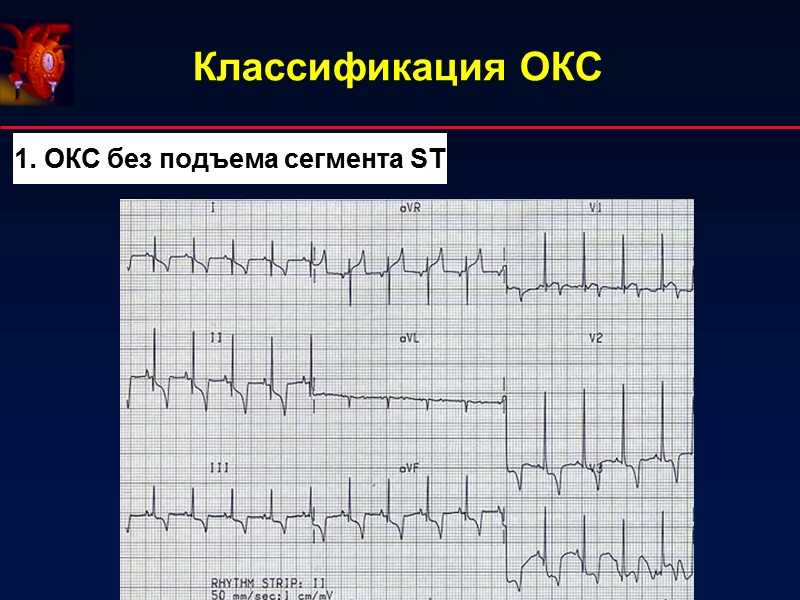 Классификация ОКС  1. ОКС без подъема сегмента ST